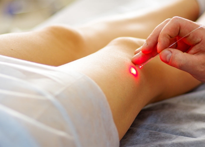 O laser endovenoso é uma ferramenta valiosa para o tratamento de varizes